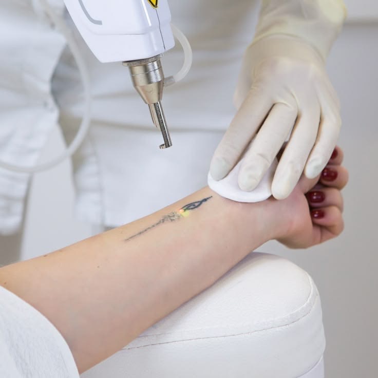 Laser Tatueringsborttagning